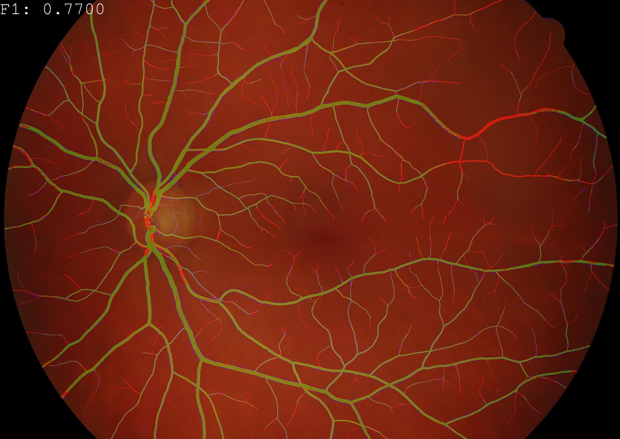 Eye imaging with vessels segmented